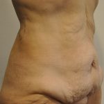 Body Lift Before & After Patient #2423