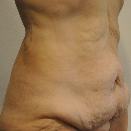Body Lift Before & After Patient #2423