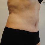 Body Lift Before & After Patient #2423