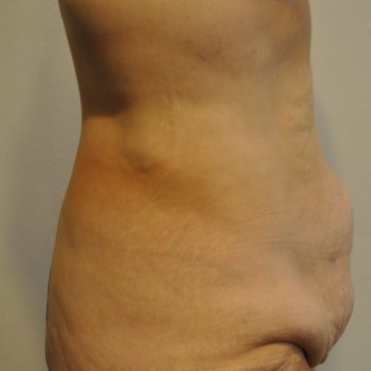 Body Lift Before & After Patient #2423