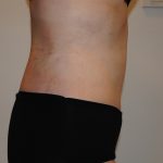 Body Lift Before & After Patient #2423