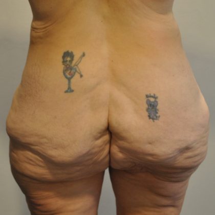 Body Lift Before & After Patient #2423