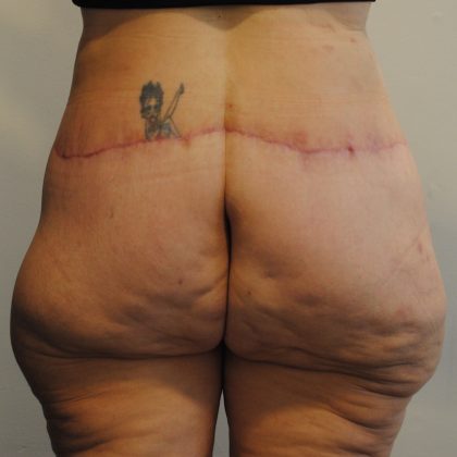 Body Lift Before & After Patient #2423