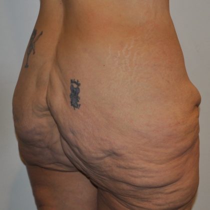 Body Lift Before & After Patient #2423