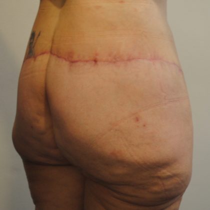 Body Lift Before & After Patient #2423