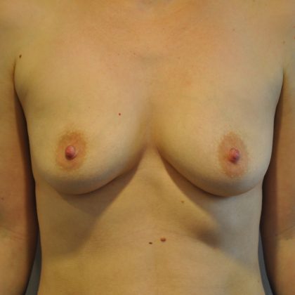 Breast Augmentation Before & After Patient #2456