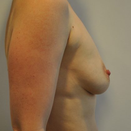 Breast Augmentation Before & After Patient #2456