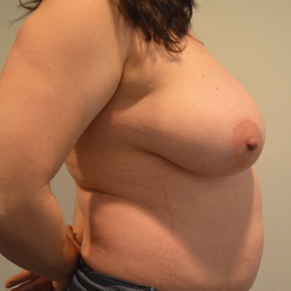 Breast Lift Before & After Patient #2637