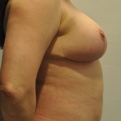 Breast Lift Before & After Patient #2637