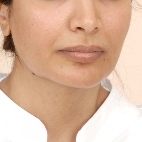 Chin Augmentation Before & After Patient #2304