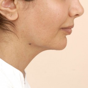 Chin Augmentation Before & After Patient #2304