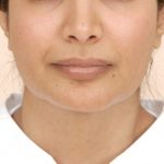 Chin Augmentation Before & After Patient #2304