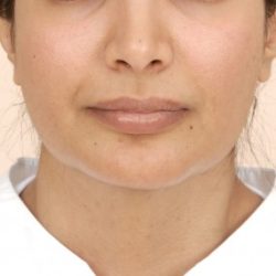 Chin Augmentation Before & After Patient #2304