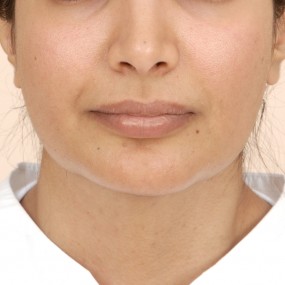 Chin Augmentation Before & After Patient #2304