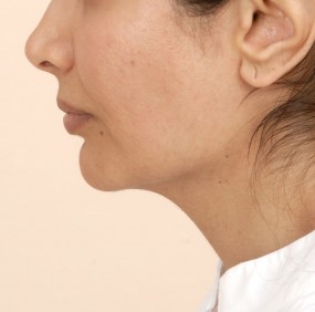 Chin Augmentation Before & After Patient #2304