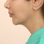 Chin Augmentation Before & After Patient #2304