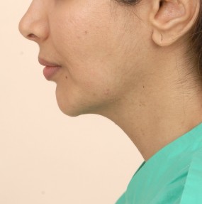 Chin Augmentation Before & After Patient #2304