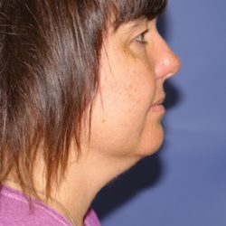 Liposuction Before & After Patient #2499