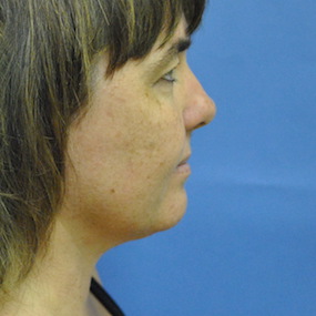 Liposuction Before & After Patient #2499