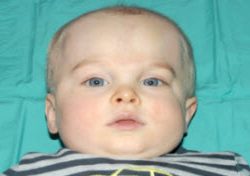 Pediatric Treatments Before & After Patient #2790
