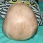 Pediatric Treatments Before & After Patient #2790