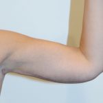 Arm Lift Before & After Patient #2591