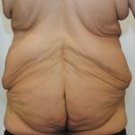 Body Lift Before & After Patient #2425