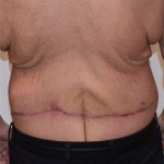 Body Lift Before & After Patient #2425