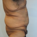 Body Lift Before & After Patient #2425