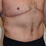Body Lift Before & After Patient #2425