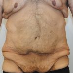 Body Lift Before & After Patient #2425