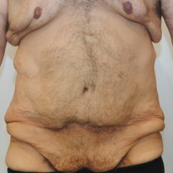 Body Lift Before & After Patient #2425