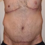 Body Lift Before & After Patient #2425