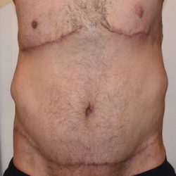 Body Lift Before & After Patient #2425
