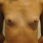 Breast Augmentation Before & After Patient #2457