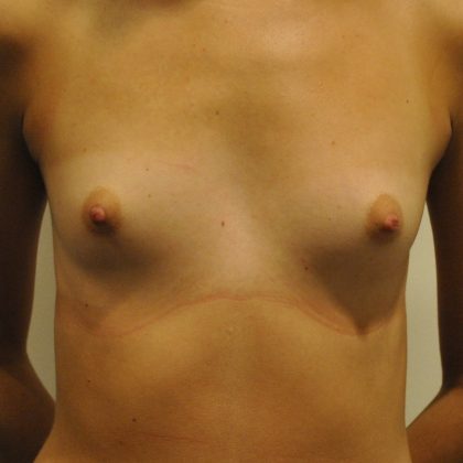 Breast Augmentation Before & After Patient #2457