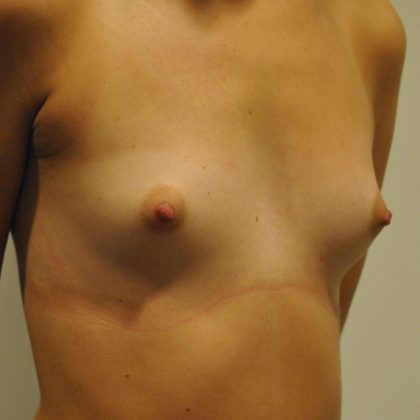 Breast Augmentation Before & After Patient #2457