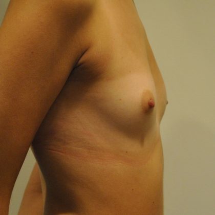 Breast Augmentation Before & After Patient #2457