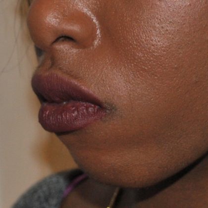 Chin Augmentation Before & After Patient #2307