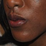 Chin Augmentation Before & After Patient #2307