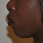Chin Augmentation Before & After Patient #2307