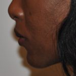 Chin Augmentation Before & After Patient #2307