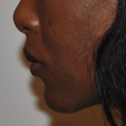 Chin Augmentation Before & After Patient #2307