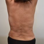 Liposuction Before & After Patient #2500