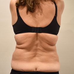 Liposuction Before & After Patient #2500