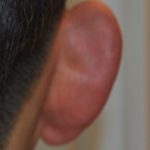 Otoplasty Before & After Patient #2296