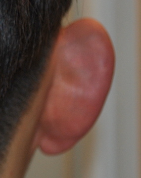 Otoplasty Before & After Patient #2296