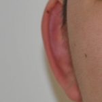Otoplasty Before & After Patient #2296