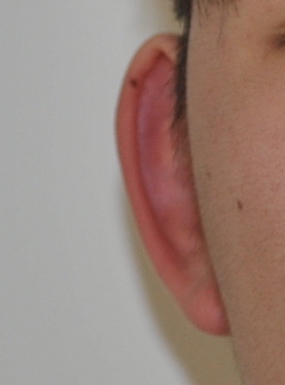 Otoplasty Before & After Patient #2296