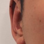 Otoplasty Before & After Patient #2296